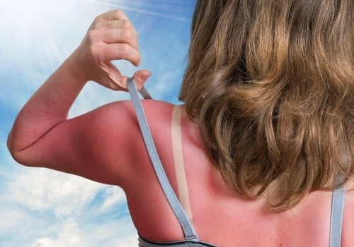 How to treat sunburn?