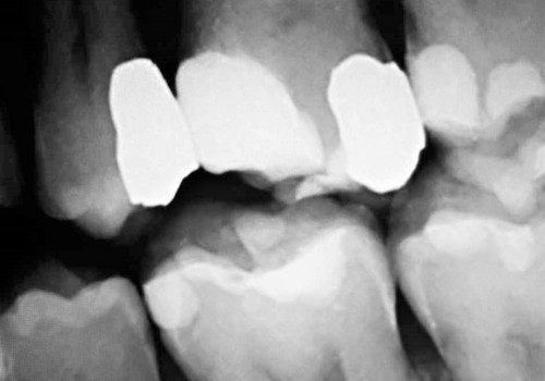 Are Dental X-Rays Safe For My Child