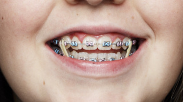 different braces bands