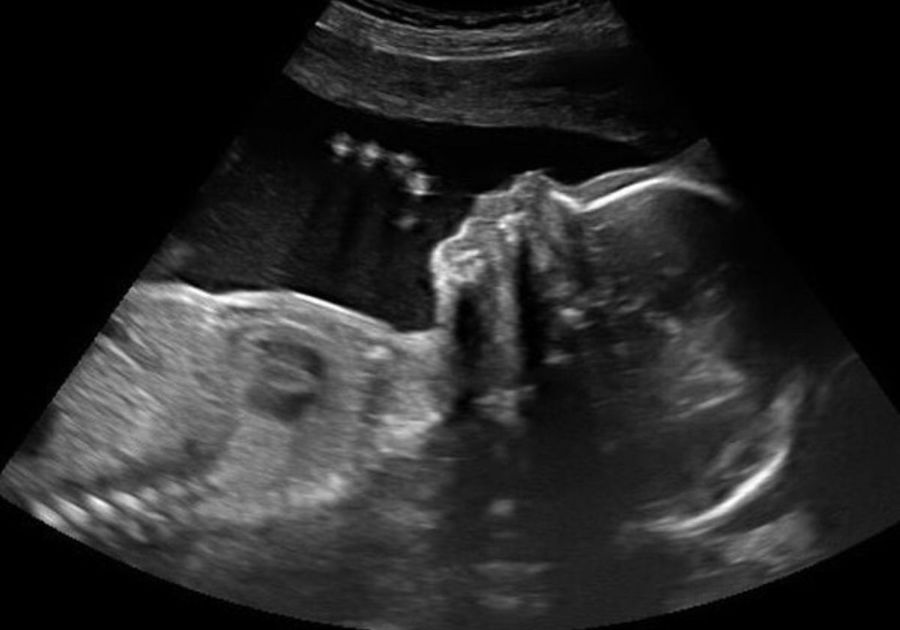 Ultrasound GE HDlive Silhouette