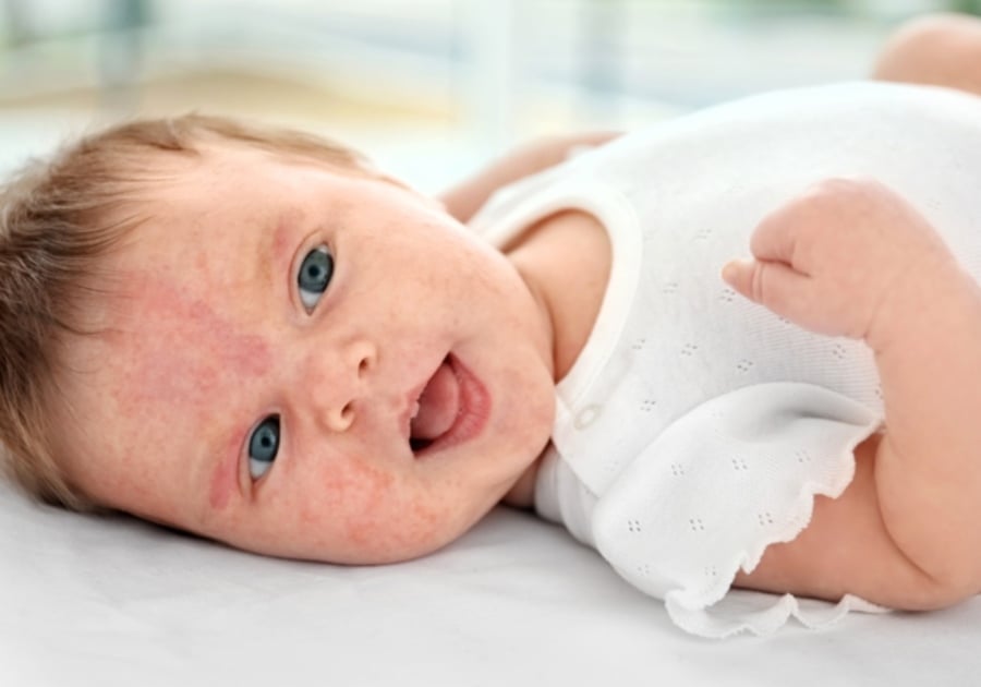 Your Baby Has Eczema